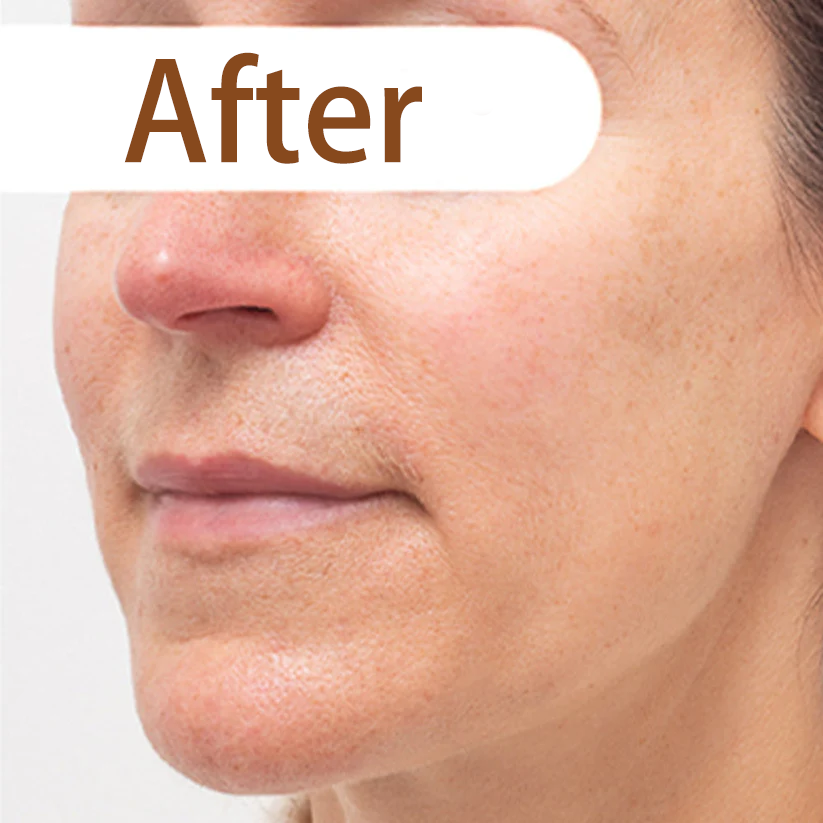 Herbal acne peeling mask