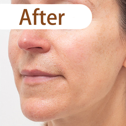 Herbal acne peeling mask