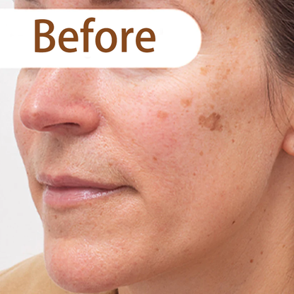 Herbal acne peeling mask
