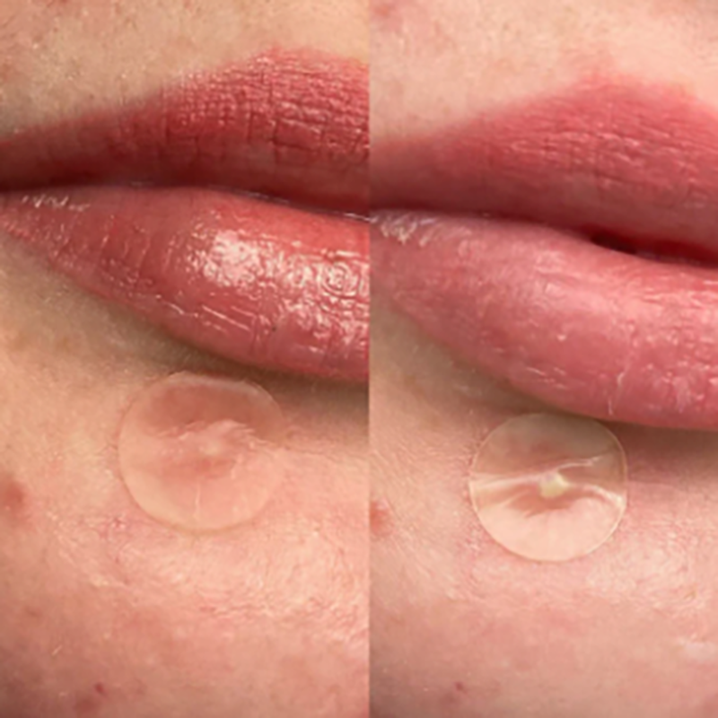 The nighttime acne patch