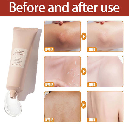 Exfoliating gel